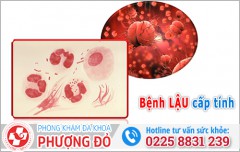 Bệnh lậu cấp tính: Dấu hiệu nhận biết sớm và hướng điều trị hiệu quả