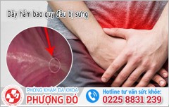 Dây hãm bao quy đầu bị sưng thì nam giới nên làm gì?