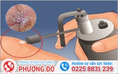Đốt Sùi Mào Gà Hậu Môn: Quy Trình Và Những Điều Cần Biết