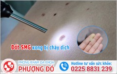 Đốt Sùi Mào Gà Xong Bị Chảy Dịch, Chảy Máu Có Sao Không?