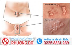 Mụn cóc sinh dục và mụn rộp sinh dục: Cách phân biệt chính xác