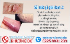 Sùi mào gà giai đoạn 2: Dấu hiệu, nguy hiểm & cách xử lý hiệu quả