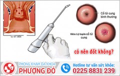 Viêm lộ tuyến cổ tử cung có nên đốt không? Giải đáp từ chuyên gia