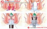 Phương pháp cắt trĩ PPH