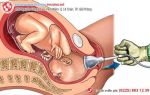 Những câu hỏi về phá thai 3 tháng tuổi