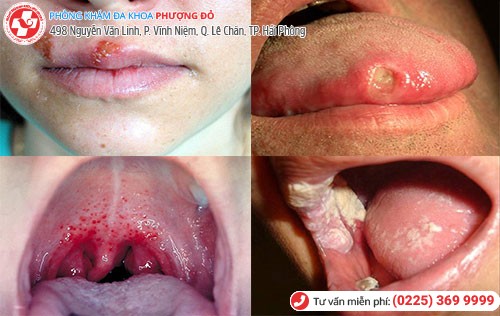 Hình ảnh bệnh lậu ở miệng 