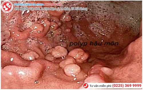 Nóng rát hậu môn là biểu hiện của bệnh polyp hậu môn trực tràng