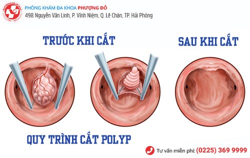 quy trình cắt polyp hậu môn