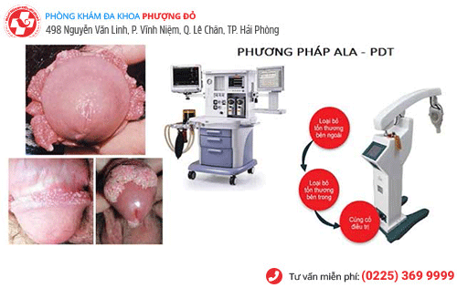 Kỹ thuật ALA-PDT điều trị sùi mào gà an toàn