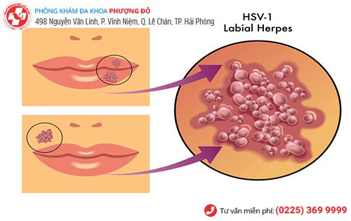 Hình ảnh virus herpes ở môi 
