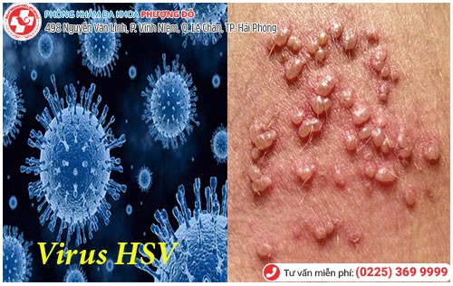 Hình ảnh mụn rộp sinh dục do virus HSV gây ra