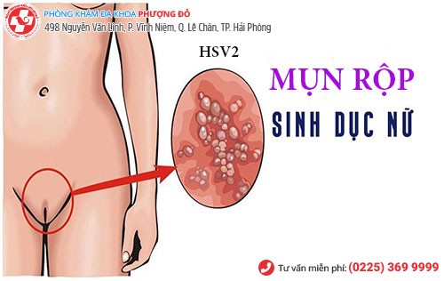 Hình ảnh mụn rộp sinh dục nữ do virus HSV gây ra