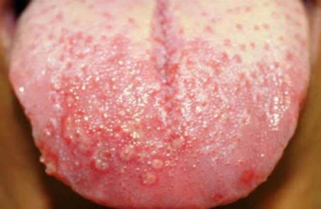 mụn rộp sinh dục ở lưỡi nguyên nhân triệu chứng và cách chữa
