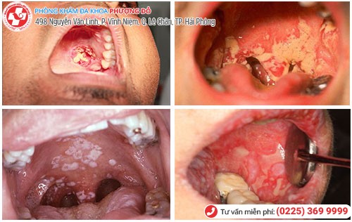 Triệu chứng bệnh lậu ở cổ họng 