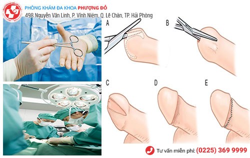 Tiểu phẫu cắt bao quy đầu theo công nghệ Hàn Quốc