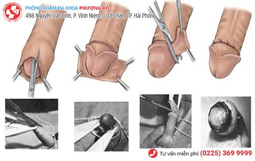 Quy trình cắt bao quy đầu bằng kỹ thuật Hàn Quốc