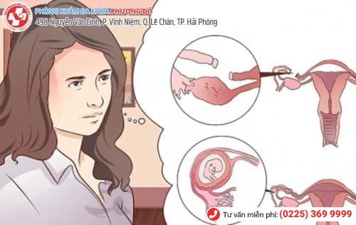 cách phá thai ngoài tử cung
