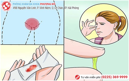 Dấu hiệu bệnh polyp tử cung