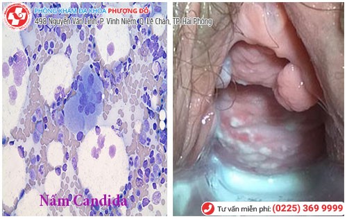Viêm âm đạo do nấm Candida gây ngứa âm đạo