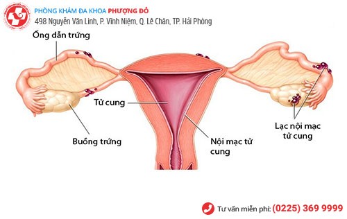 Hình ảnh bệnh lạc nội mạc tử cung