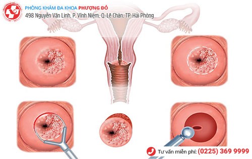 Hình ảnh bệnh nấm ở tử cung