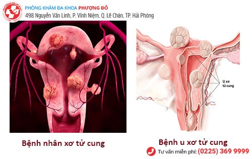 Hình ảnh bệnh nhân xơ tử cung và u xơ tử cung