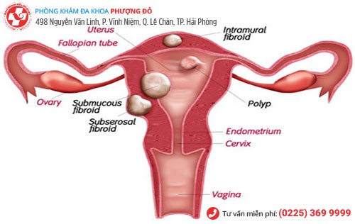 Hình ảnh bệnh polyp tử cung