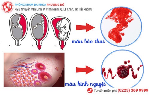 Sự khác nhau giữa máu báo thai và máu kinh nguyệt