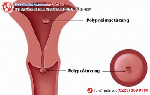 Polyp lòng tử cung là gì?