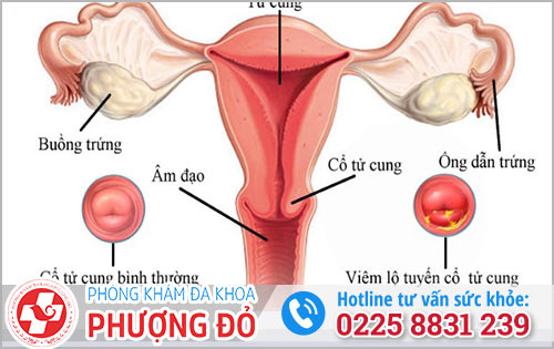 Vì sao nữ giới mắc viêm lộ tuyến cổ tử cung?
