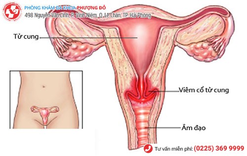 Viêm cổ tử cung là gì? Nguyên nhân triệu chứng và cách chữa trị hiệu quả
